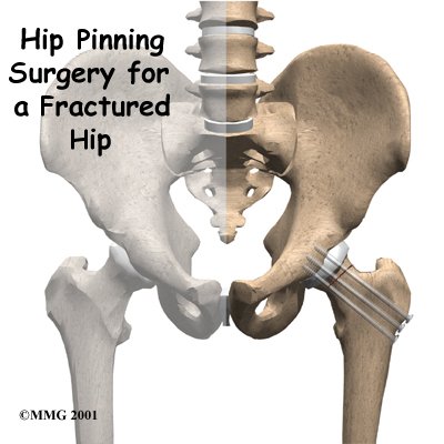 Hip Pinning Surgery for a Fractured Hip