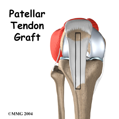 Patellar Tendon Graft Reconstruction of the ACL